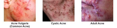 Nodular Acne Vs Cystic Acne