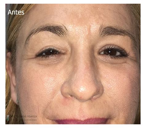 Antes Y Despu S Par Lisis Facial Salom Abenza