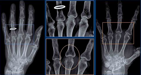 The Radiology Assistant Arthritis