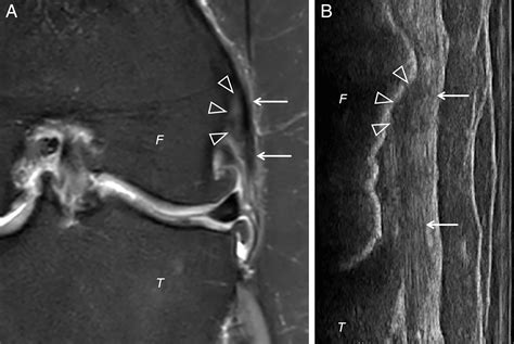 Imaging Characteristics Of The Proximal Lateral Collateral Ligament Of The Knee Findings On