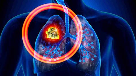 Current treatment option for chest wall Ewing Sarcoma