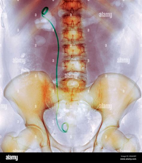 Urinary System Stent X Ray Stock Photo Alamy