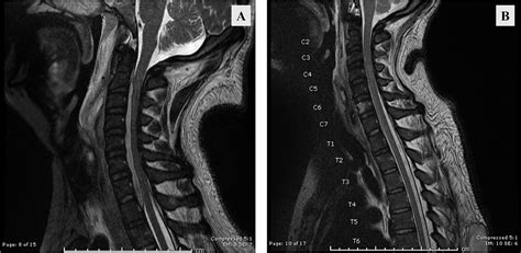 Anterior Transcorporeal Full Endoscopic Drainage Of A Long Span Ventral