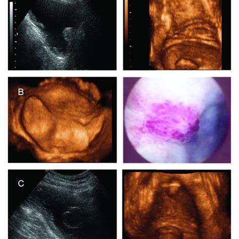 (A) A B-mode ultrasound image of a bladder in a transverse section ...