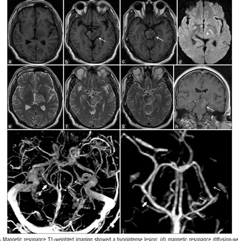 Figure 1 From Unilateral Isolated Basal Vein Thrombosis Associated With