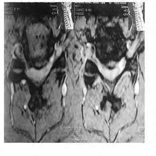 MRI cervical spine sagittal (A) and Axial (B) Views showing multiple... | Download Scientific ...