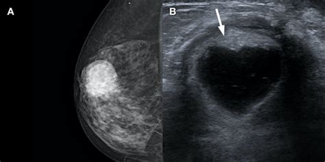 Breast Cyst Ultrasound