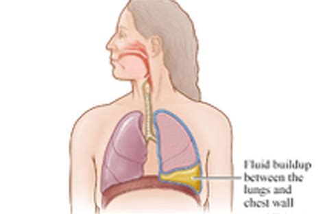 Fluid In The Lungs