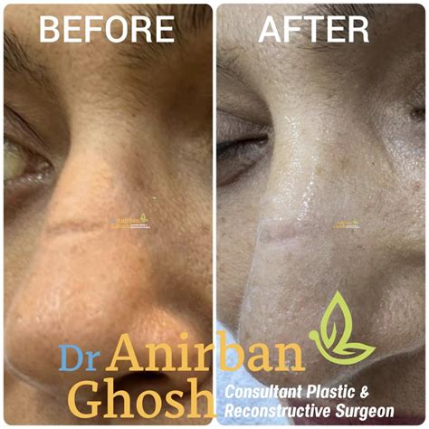 Before After Dr Anirban Ghosh Top Plastic Surgeon In Kolkata