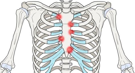 Costocondritis por COVID 19 qué es y cómo se trata