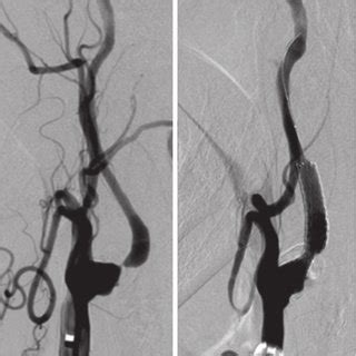 A Preoperative Left Common Carotid Angiogram Lateral View Showed