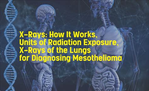 X Rays How It Works Units Of Radiation Exposure X Rays Of The Lungs For Diagnosing Mesothelioma