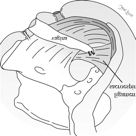 Fixação Da Cúpula Vaginal No Ligamento Sacroespinhal Download