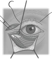 Lateral Canthopexy