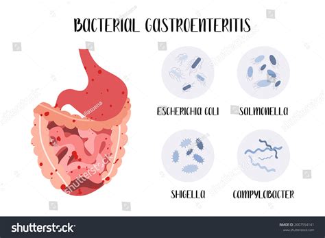 Bacterial Gastroenteritis Stomach Gastric Gut Intestine Stock Vector