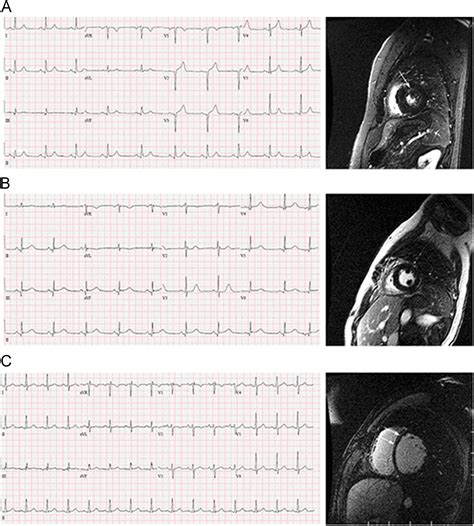 Does The Presence Of Q Waves On The Ekg Accurately Predict Prior