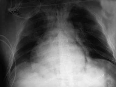 Pneumothorax Workup Approach Considerations Arterial Blood Gas