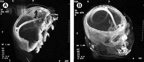 cribriform plate | The Trauma Pro