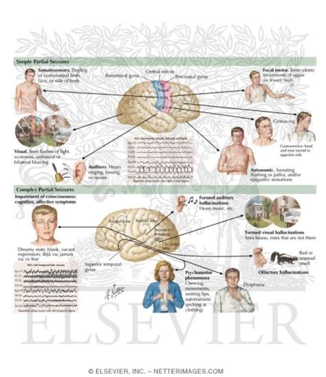 Simple Partial Seizure EEG