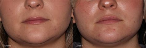 Lip Flip Botox Before And After Photos - Infoupdate.org