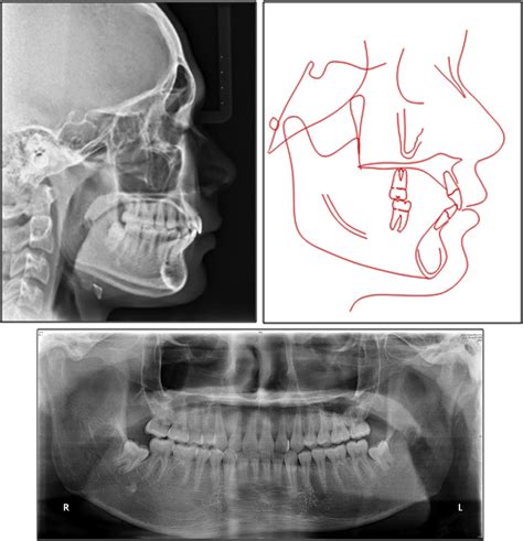 Figure From Severe Class Ii Division Malocclusion In An Adolescent