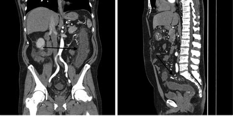 Contrast Enhanced Abdominal Ct Images Of Inferior Mesenteric Avm