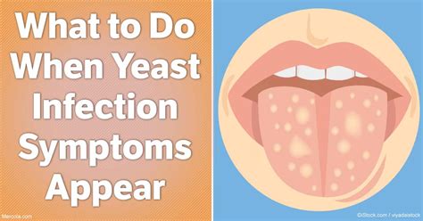 What to Do When Yeast Infection Symptoms Appear