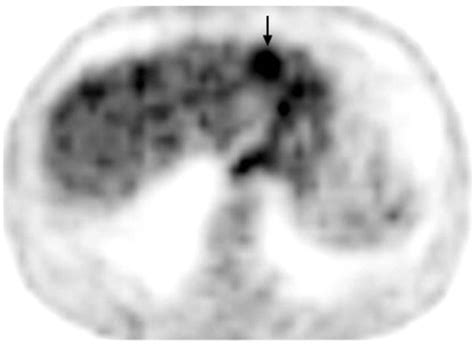 PET CT Of Esophageal Cancer Its Role In Clinical Management