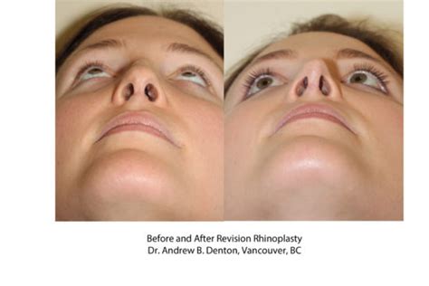 Before And After Revision Rhinoplasty Dr Denton