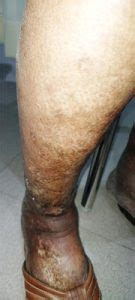 Varicose Veins Treatment In Kochi Keyhole Clinic