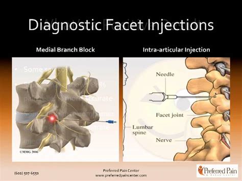 Lumbar Facet Joint Nerve Injections For Treating Chronic Low Back Pain