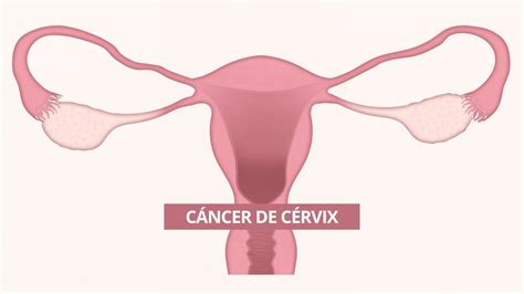 Qué es el cáncer de cérvix o cuello del útero síntomas y tratamientos