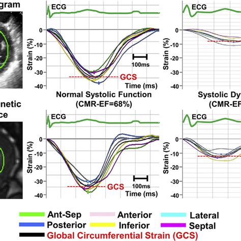 PDF Global Longitudinal Strain And Global Circumferential Strain By