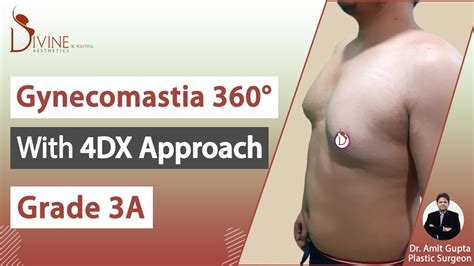 Gynecomastia 360° Grade 3a 4dx Approach Dr Amit Gupta Plastic