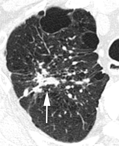 State Of The Art Imaging Of Occupational Lung Disease Radiology