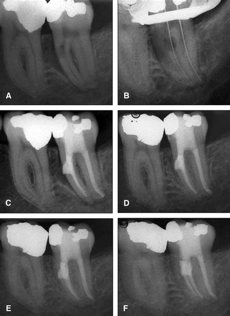 Treatment of Internal Root Resorption with MTA: Theoretical Review | perio.prostho.cc - passion ...