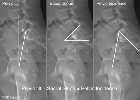 Pelvis Radiograph Labeled