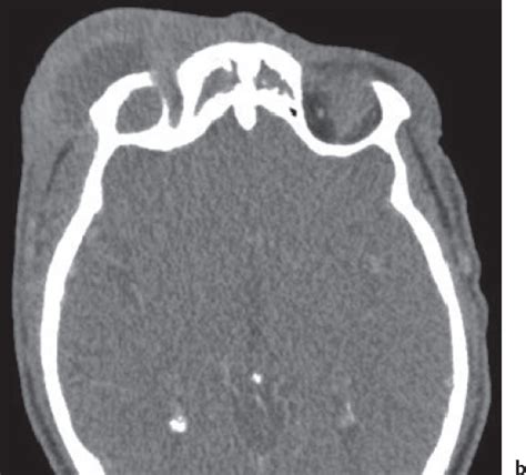 Complications of Acute Rhinosinusitis | Ento Key