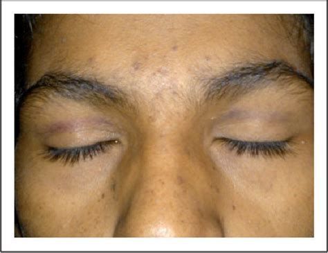 Figure 1 From Bilateral Eyelid Ecchymosis And Subconjunctival Haemorrhage Manifesting As