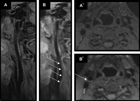 The Use Of Intracranial Vessel Wall Imaging In Clinical Practice