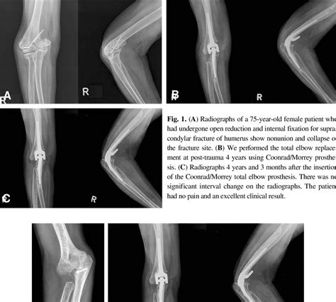 Figure 1 From Total Elbow Arthroplasty After Failed Surgical Treatment For Elbow Fracture Or