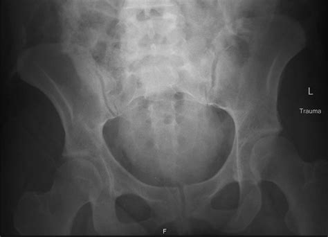 Pelvic X Ray Showing Intact Pelvic Ring Download Scientific Diagram