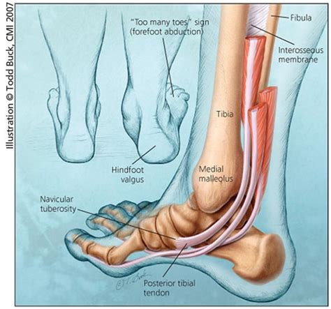 Posterior Tibial Tendon Anatomy