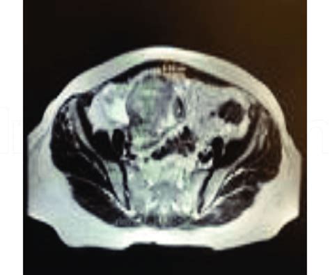 Endometrioma Cyst Ultrasound