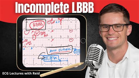 Incomplete Left Bundle Branch Block ILBBB EKG ECG Lecture YouTube