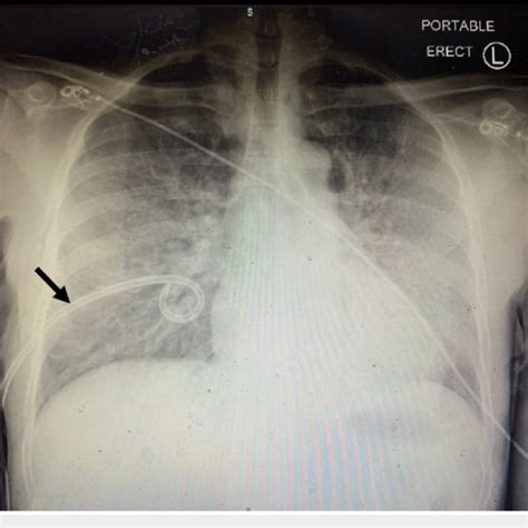 Chest X Ray Following The Chest Tube Placement Arrow Showed