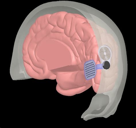 New System Aims to Help Blind Patients with Optic Nerve Damage - PIE