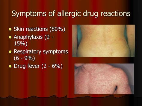 Ppt Drug Allergy Powerpoint Presentation Free Download Id6389128