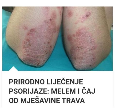 Prirodni Lijekovi Za Psorijazu Biljne Mje Avine Melema I Ajeva