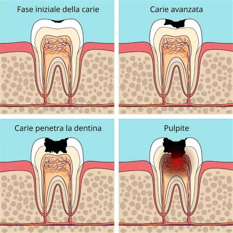 Pulpite Segni Dell Infiammazione Del Nervo Dentale